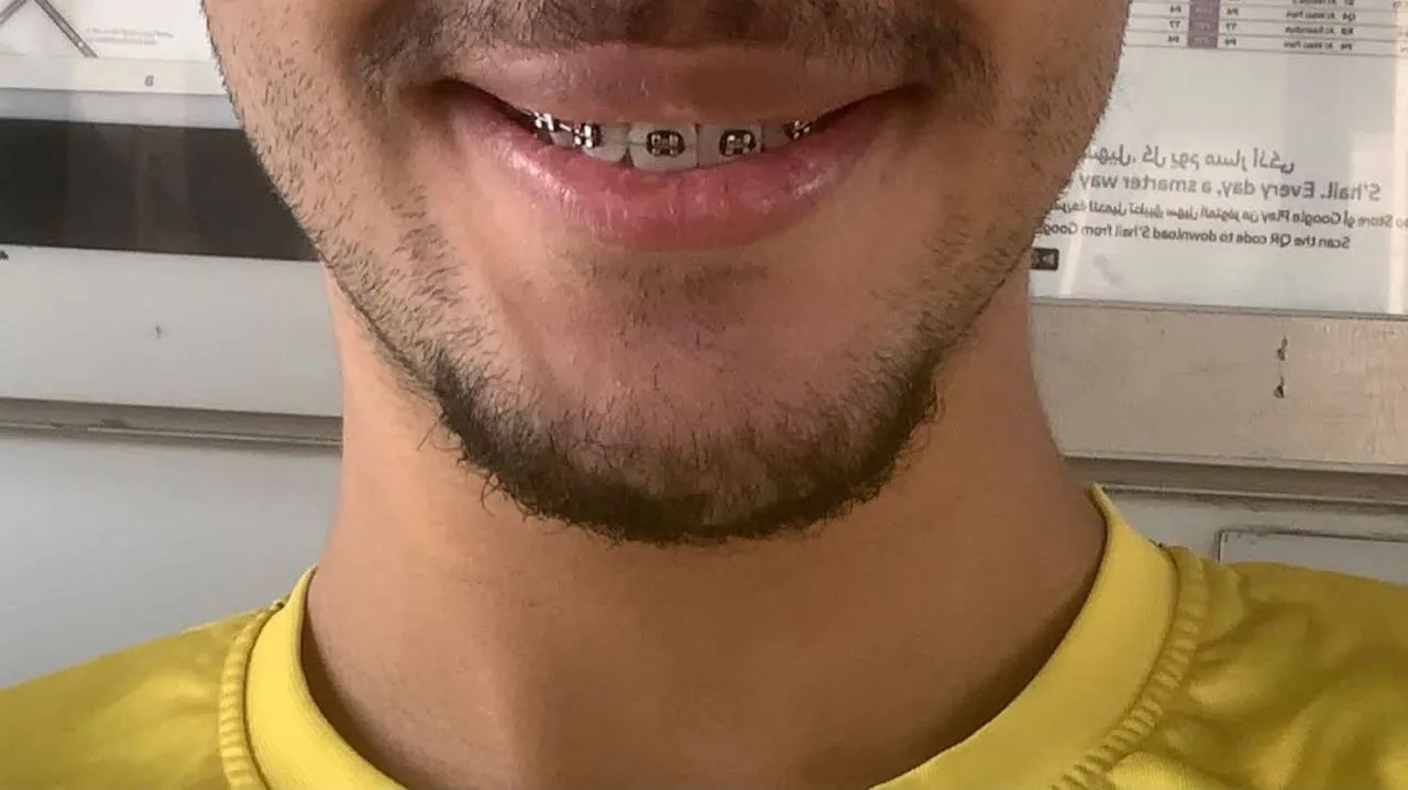 Smiling patient wearing metal braces