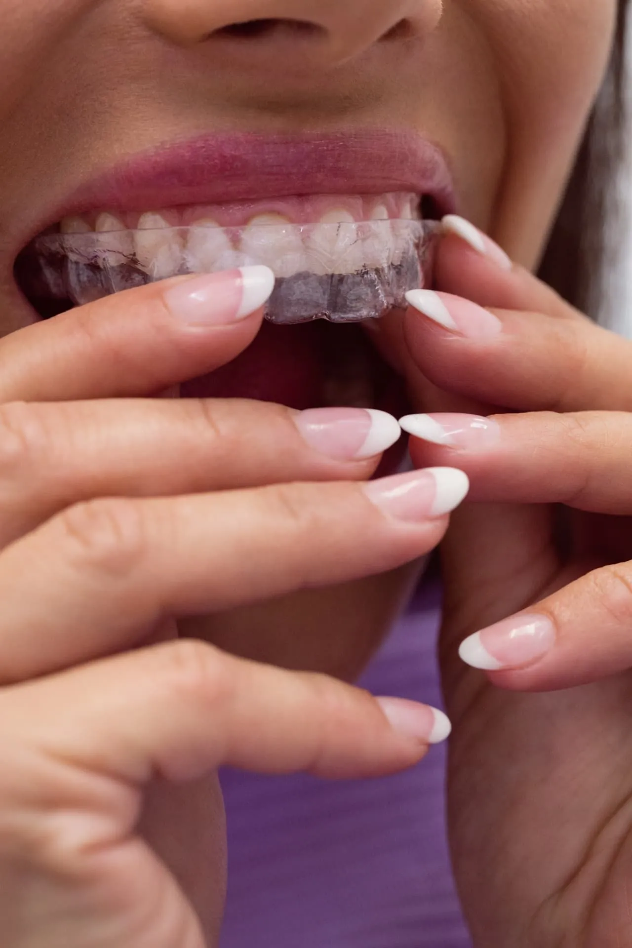 Patient fitting a clear retainer