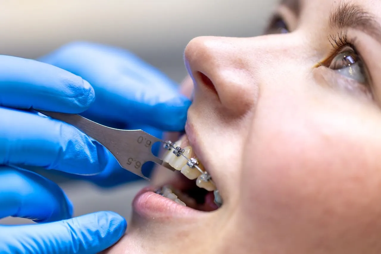 Dentist checking self-ligating braces on a patient