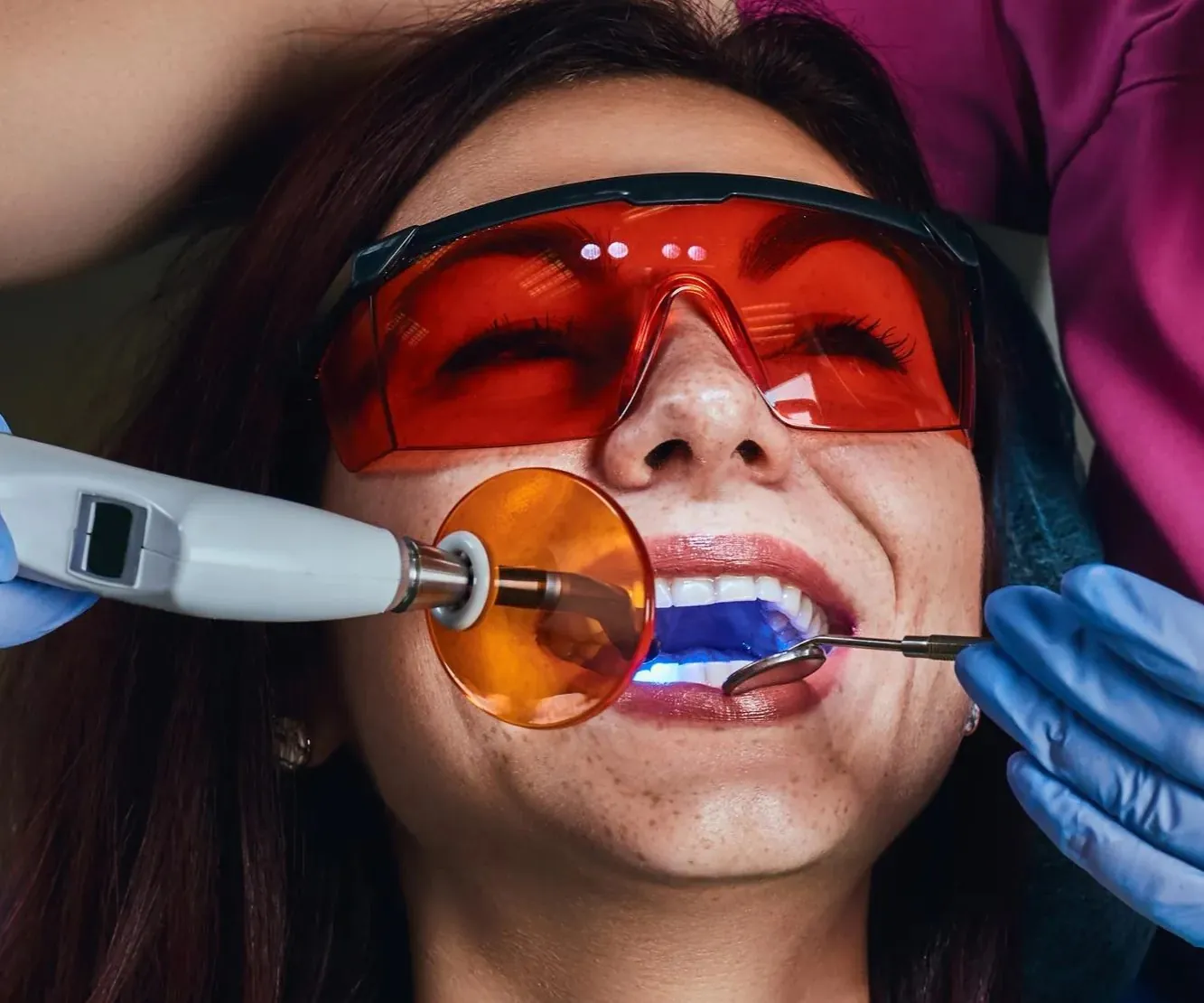Dental Fillings